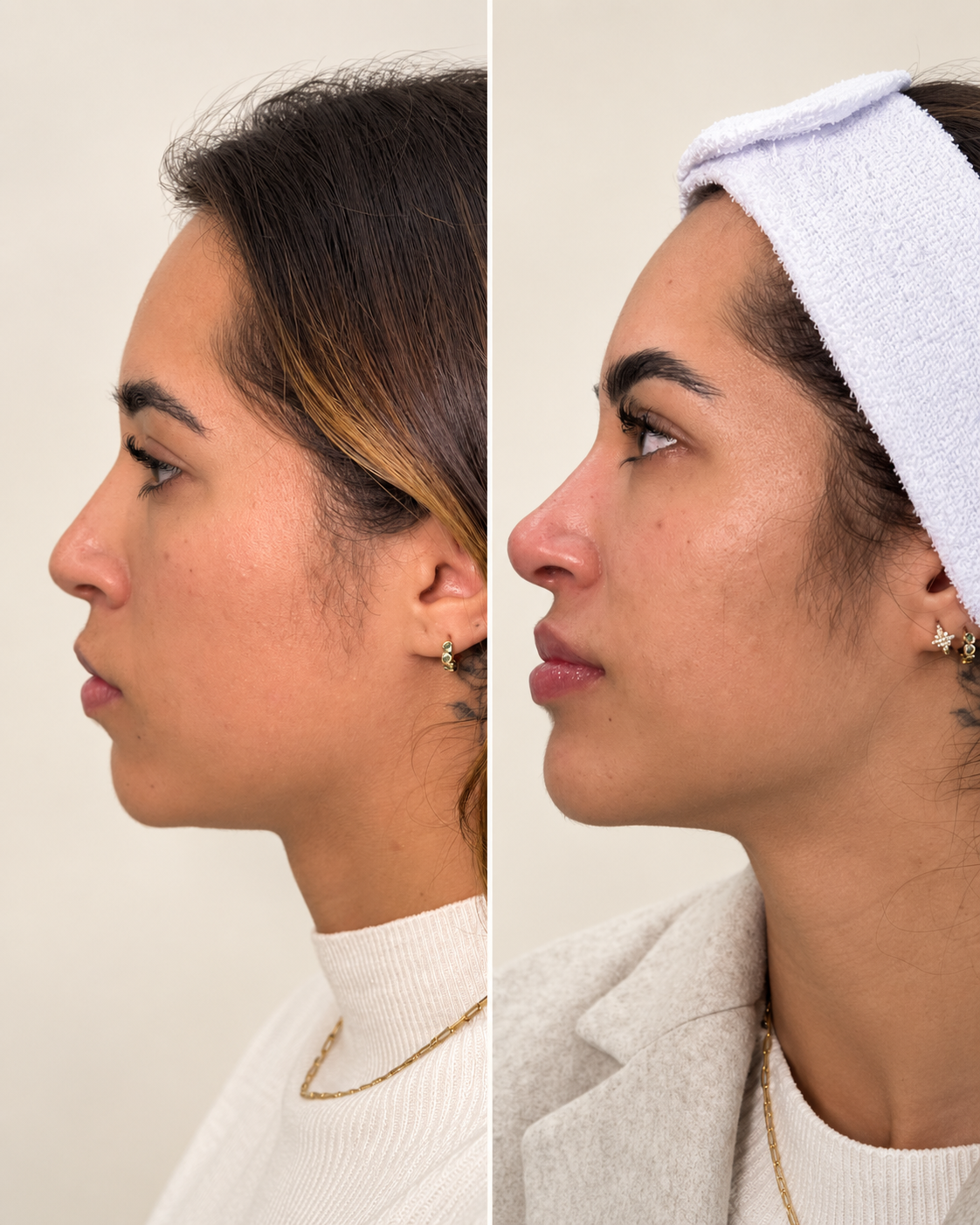 Caso 01: comparação de antes e depois de planejamento Full Face