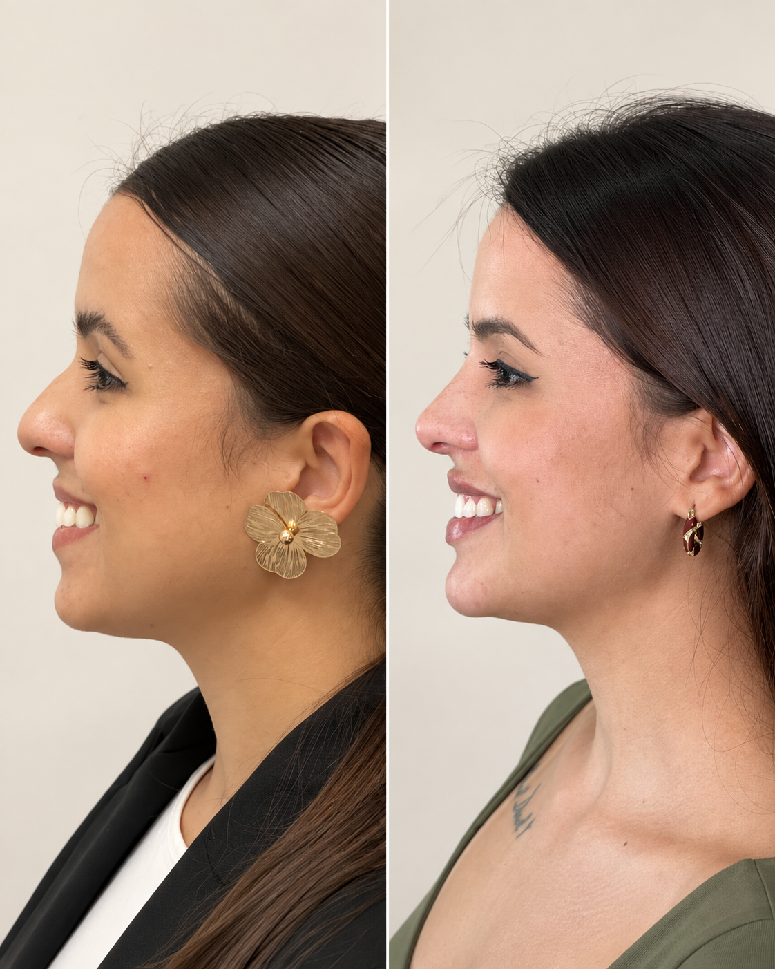 Caso 02: comparação de antes e depois de planejamento Full Face