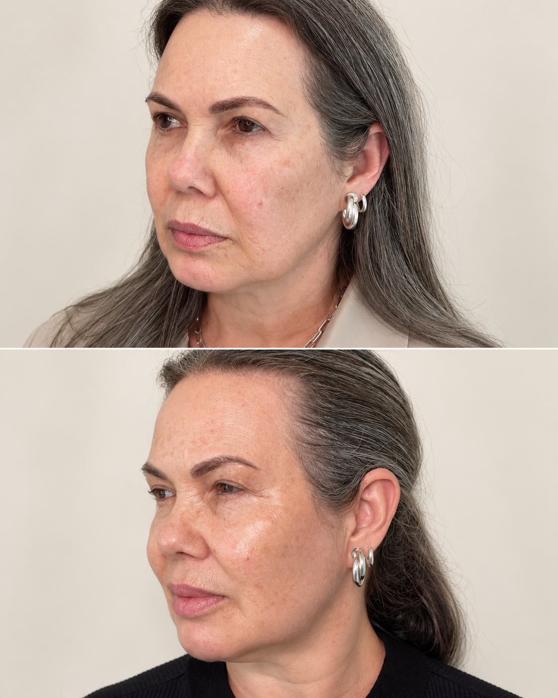 Caso 03: comparação de antes e depois de planejamento Full Face